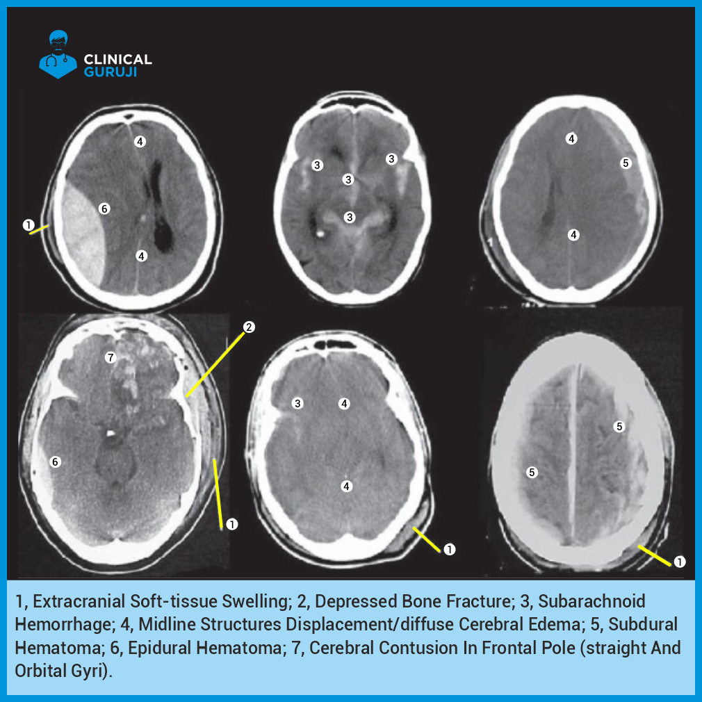 Decoding CT Head Scans 7 Key Findings For Accurate Diagnoses And 