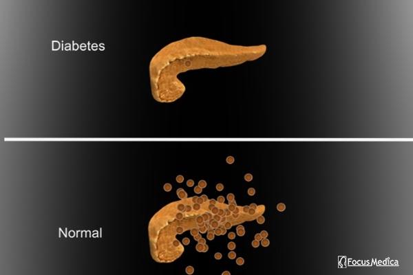Animated Atlas of Diabetes and its Management cover
