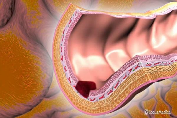 Animated Atlas of Crohn’s disease cover