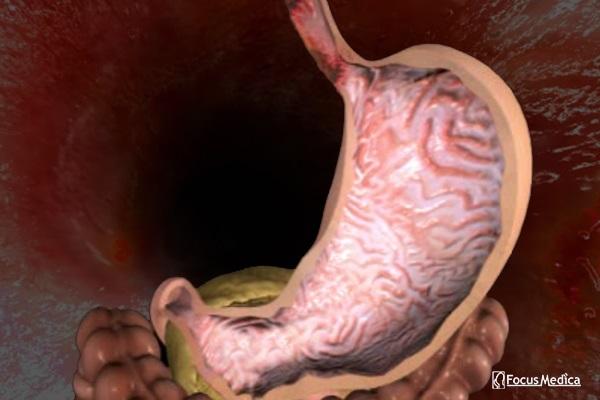 Animated Atlas of Gastro Esophageal Reflux Disease (GERD) cover
