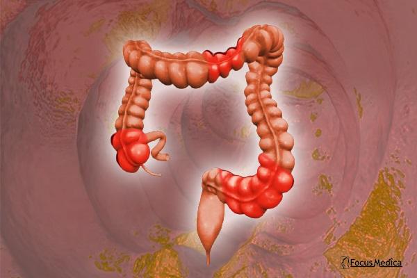 Animated Atlas of Ulcerative Colitis cover