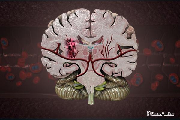 Animated Atlas of Spasticity cover
