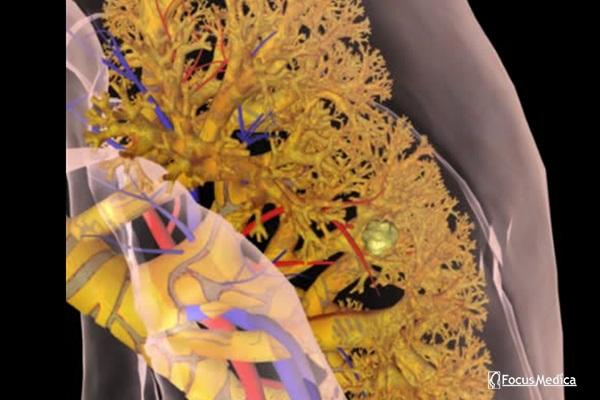 Animated Atlas of Lung Cancer cover