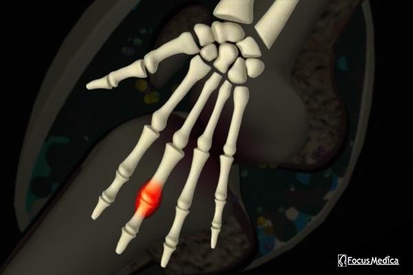 Animated Atlas of Osteoarthritis cover