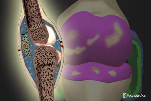 Animated Atlas of Rheumatoid Arthritis cover