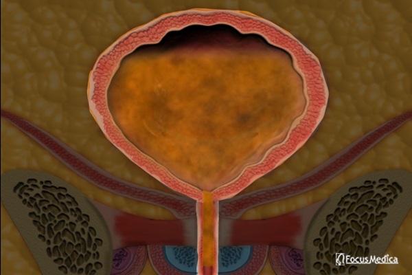 Animated Atlas of Overactive Bladder cover