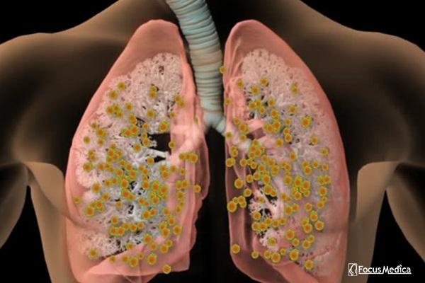 Animated Atlas of Chronic Asthma cover