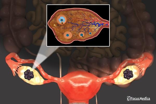 Animated Atlas of Ovarian Cancer cover