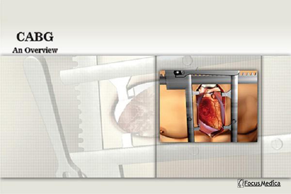 Coronary Artery Bypass Graft cover
