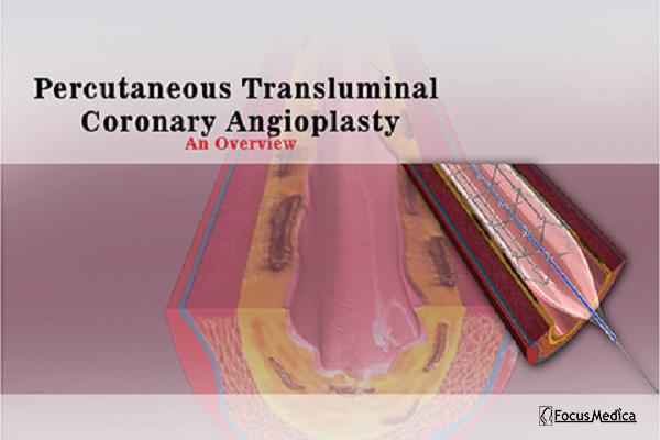 PTCA cover