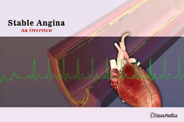 Stable Angina cover