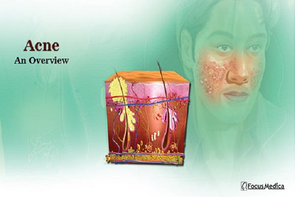 Acne cover