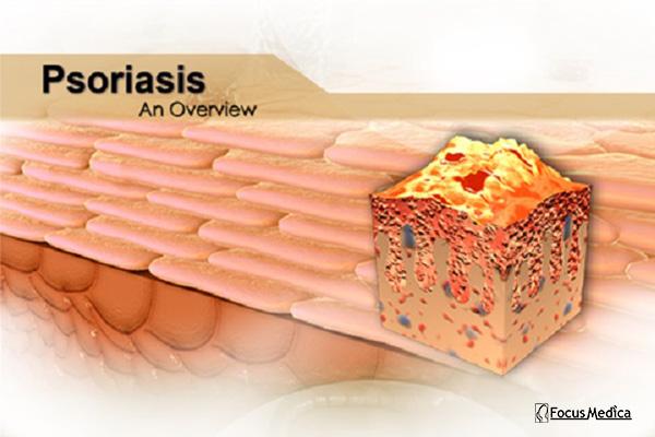 Psoriasis cover