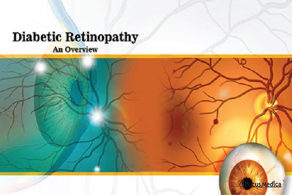 Diabetic Retinopathy cover