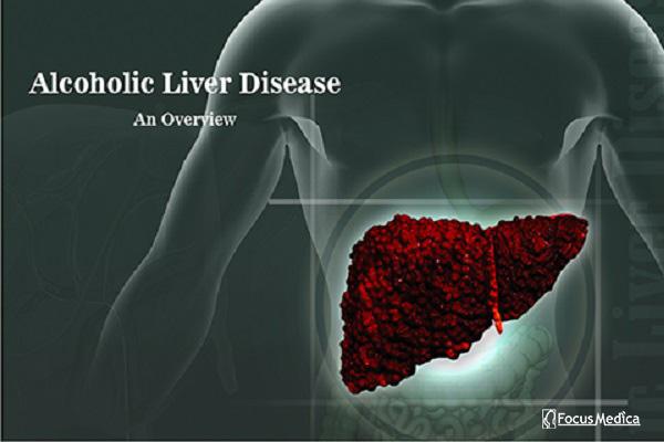 Alcoholic Liver Disease cover