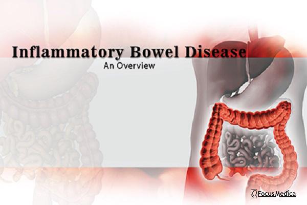 Inflammatory Bowel Disease cover