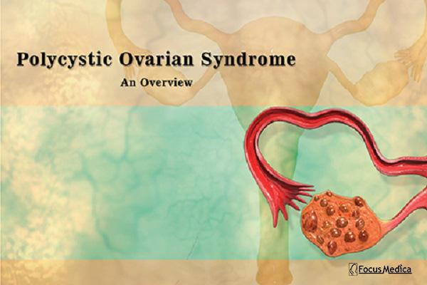 Polycystic Ovarian Syndrome cover