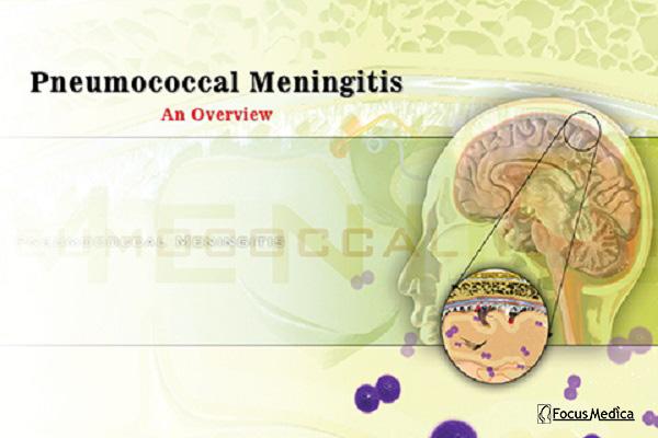 Pneumococcal meningitis cover