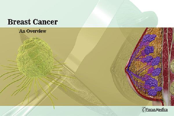 Breast Cancer cover