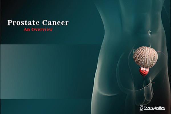 Prostate cancer cover