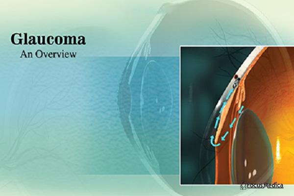Glaucoma (An Overview) cover