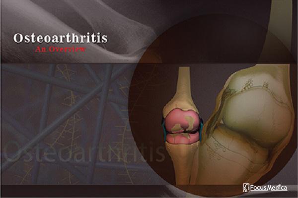 Osteoarthritis cover