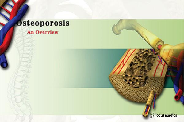 Osteoporosis cover