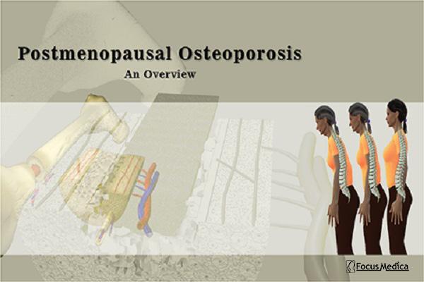 Postmenopausal Osteoporosis cover