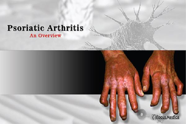 Psoriatic Arthritis cover