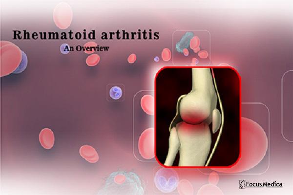 Rheumatoid Arthritis cover