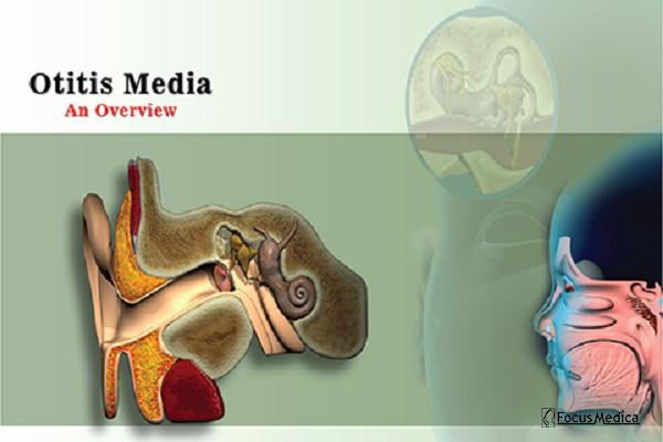 Otitis Media cover