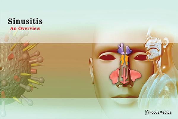 Sinusitis cover