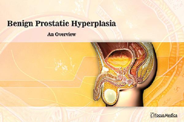 Benign Prostatic Hyperplasia cover