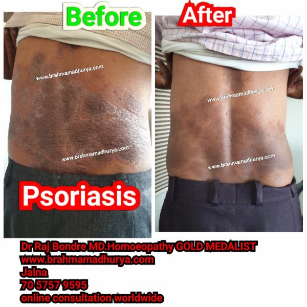 Mega webinar on psoriasis Dr Raj Bondre cover