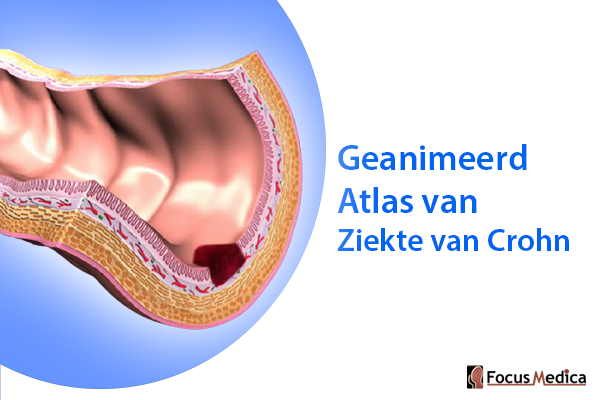 Geanimeerde Atlas van Ziekte van Crohn cover