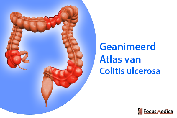 Geanimeerde Atlas van Colitis ulcerosa cover