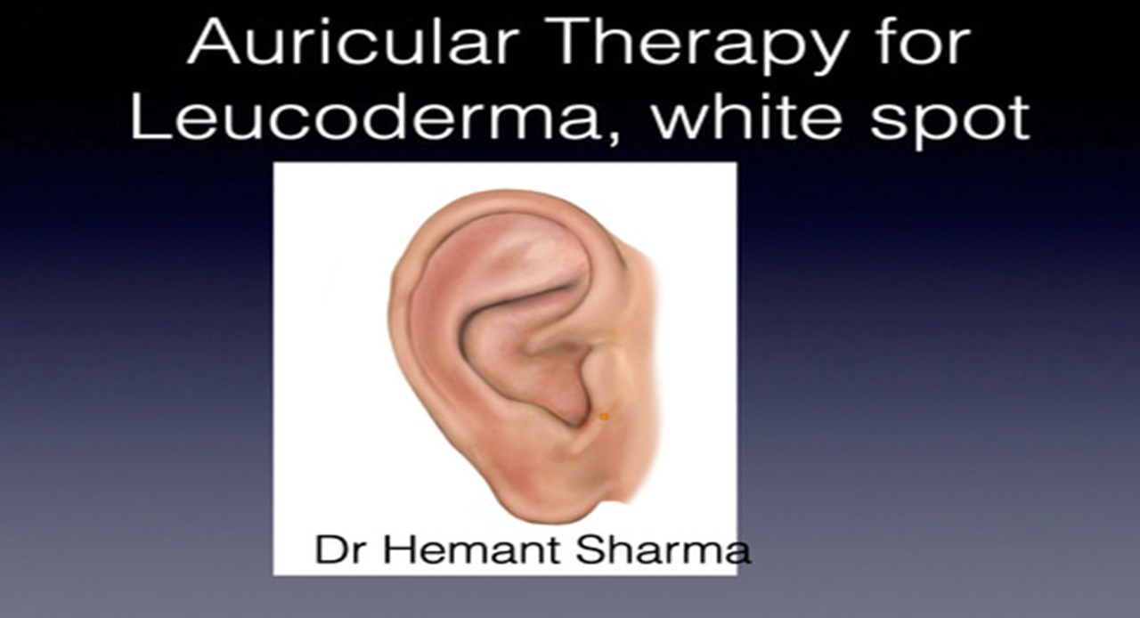 AURICULAR ACUPUNCTURE/ SEED THERAPY FOR VITLIGO cover