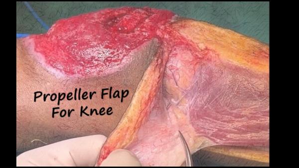 Propeller Flap for Knee defect cover