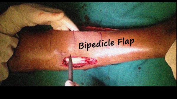Bipedicled Flap for Leg defect cover