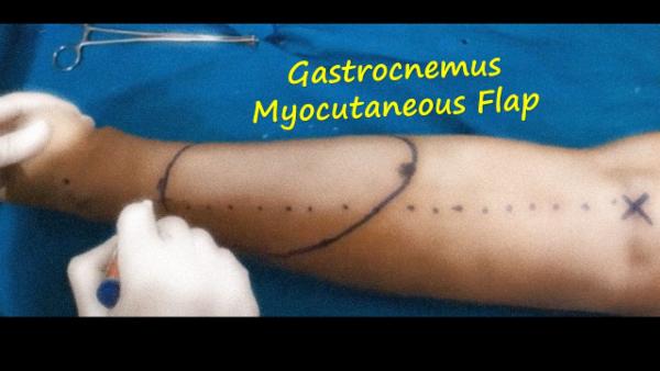Gastrocnemus Myocutaneous Flap cover