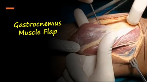 Gastrocnemus Muscle Flap cover
