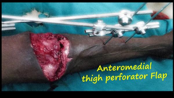 Anteromedial thigh flap for knee defect cover