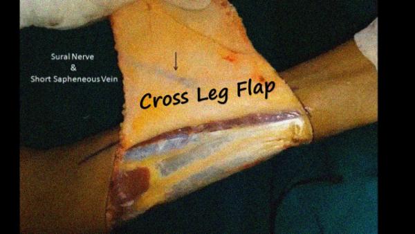 Cross Leg Flap cover