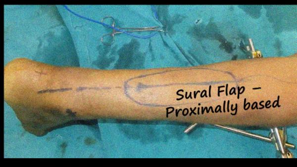 Sural Flap - Proximally based cover