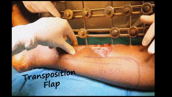 Transposition flap cover