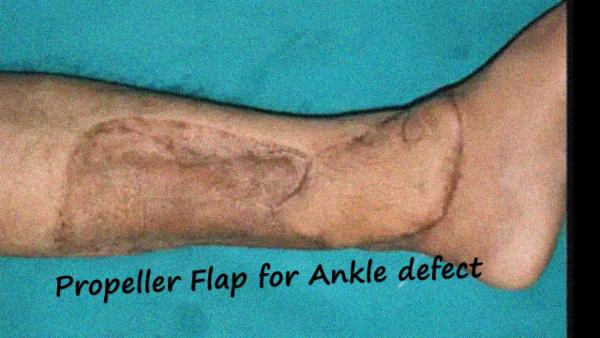 Propeller Flap for Leg defect cover