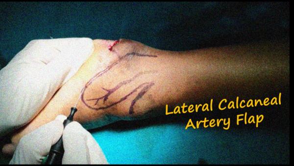 Lateral Calcaneal artery flap cover