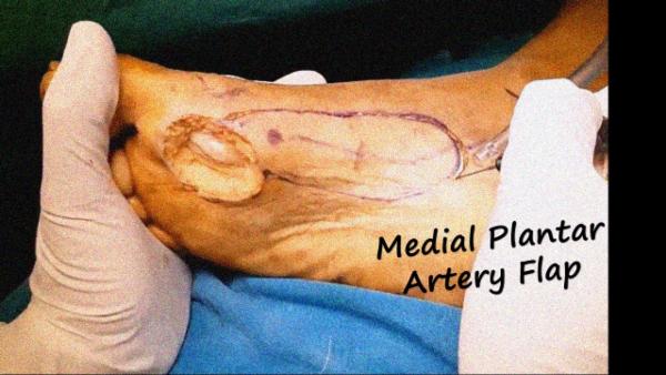 Reverse Medial Plantar artery Flap cover