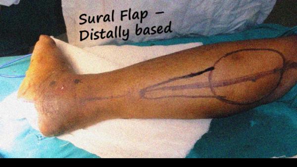 Sural Flap - Distally based cover