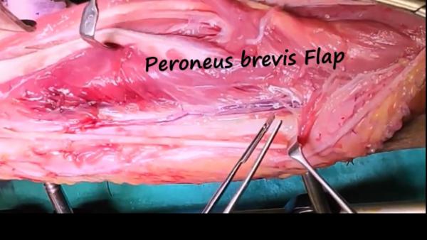 Peroneus Brevis Flap cover